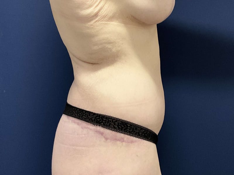 Tummy Tuck by Dr. Booth Before & After Gallery - Patient 233202 - Image 6