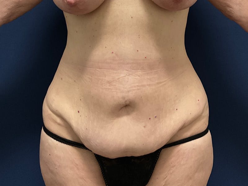 Tummy Tuck by Dr. Booth Before & After Gallery - Patient 127056 - Image 3