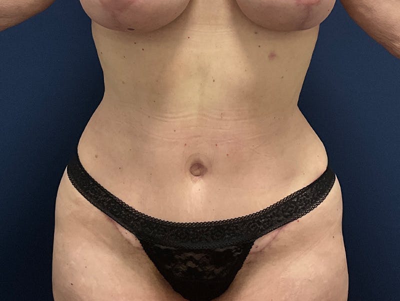 Tummy Tuck by Dr. Booth Before & After Gallery - Patient 127056 - Image 4