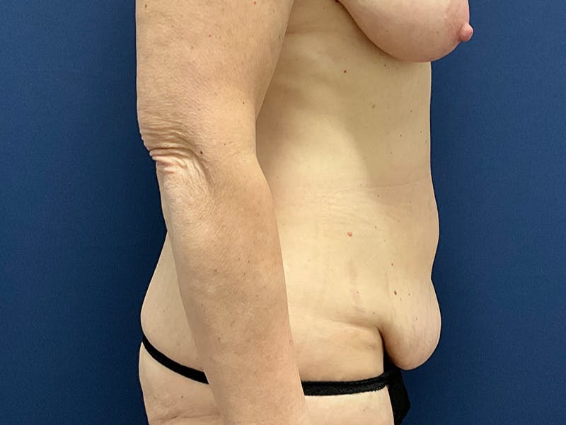 Tummy Tuck by Dr. Booth Before & After Gallery - Patient 127056 - Image 7