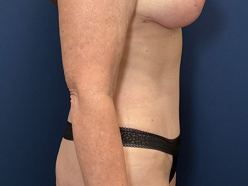Tummy Tuck by Dr. Booth Before & After Gallery - Patient 127056 - Image 8