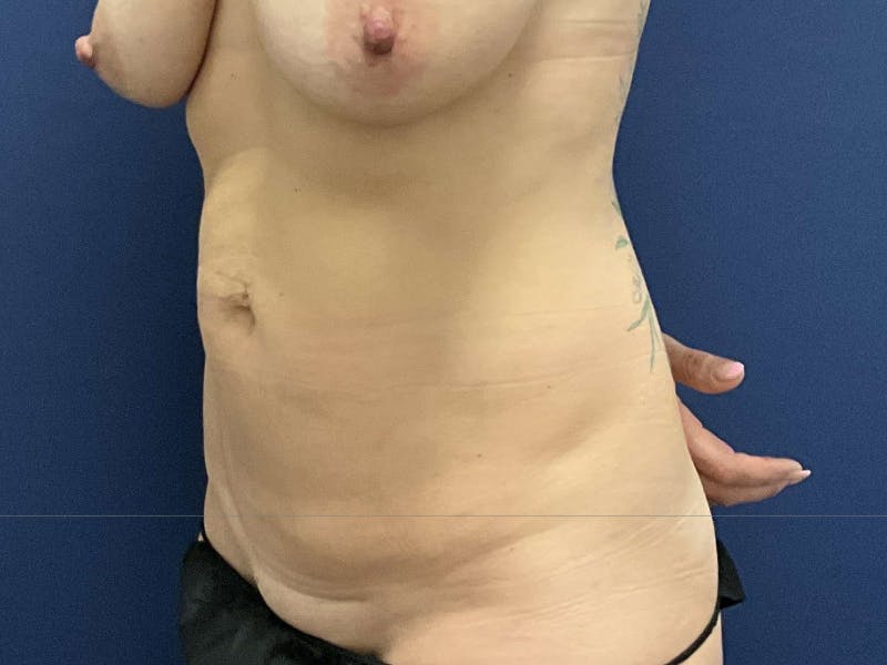 Tummy Tuck by Dr. Booth Before & After Gallery - Patient 283343 - Image 1