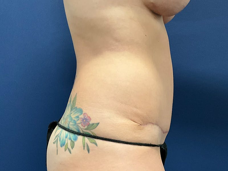 Tummy Tuck by Dr. Booth Before & After Gallery - Patient 220225 - Image 6