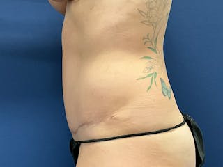 Tummy Tuck by Dr. Booth Before & After Gallery - Patient 220225 - Image 10
