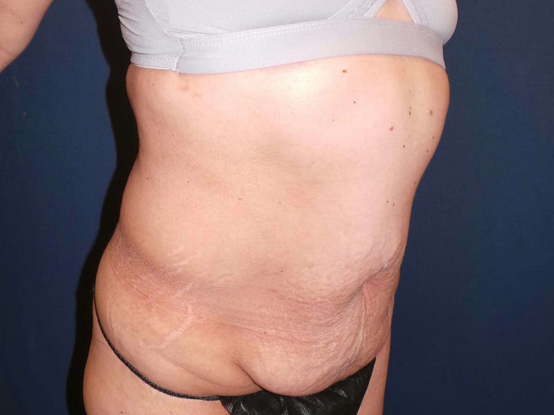 Tummy Tuck by Dr. Booth Before & After Gallery - Patient 347784 - Image 1