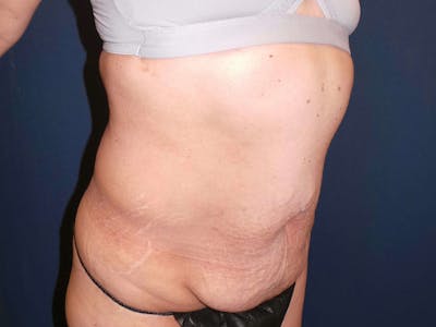 Tummy Tuck by Dr. Booth Before & After Gallery - Patient 347784 - Image 1