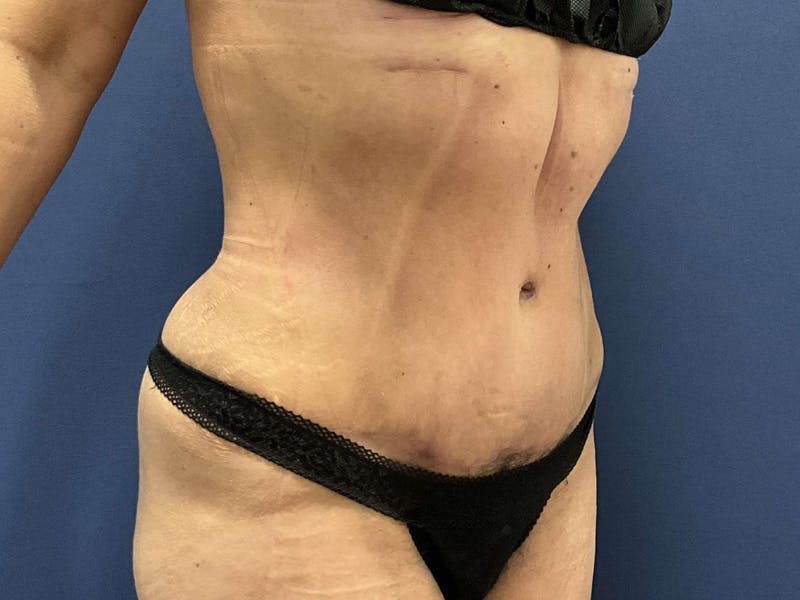 Tummy Tuck by Dr. Booth Before & After Gallery - Patient 347784 - Image 2