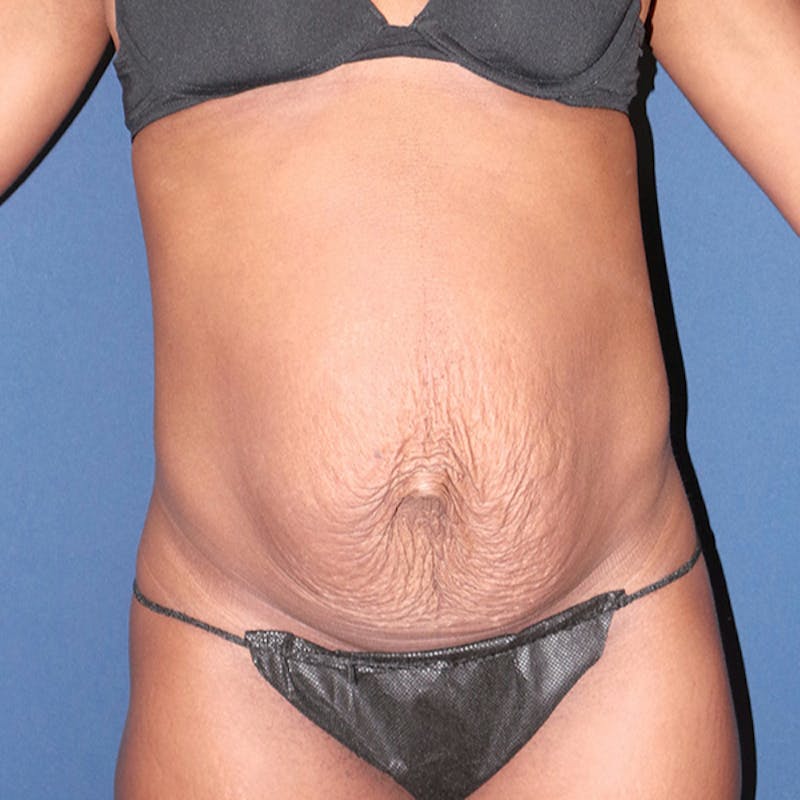 Tummy Tuck by Dr. Booth Before & After Gallery - Patient 233458 - Image 1