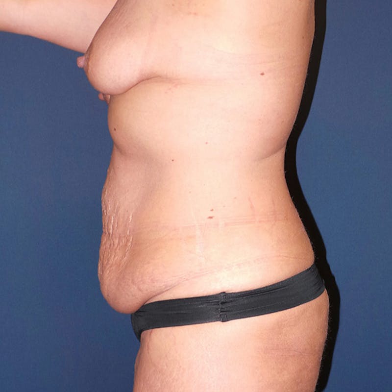 Tummy Tuck by Dr. Booth Before & After Gallery - Patient 218354 - Image 3