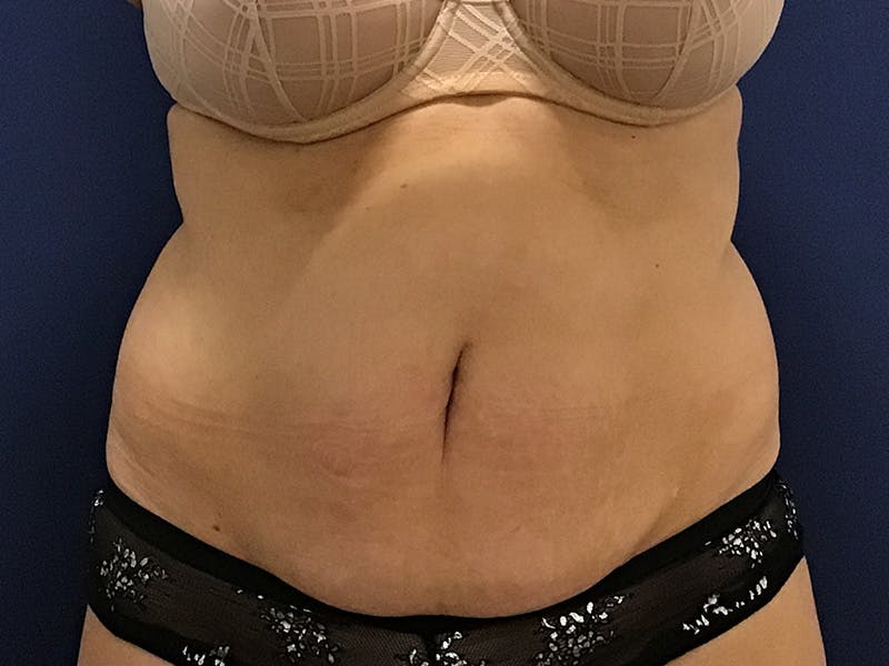 Tummy Tuck by Dr. Booth Before & After Gallery - Patient 90112745 - Image 1