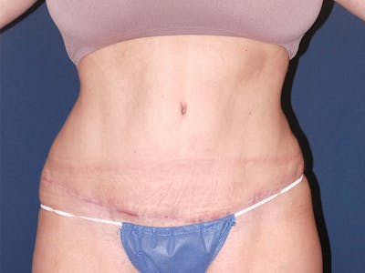 Tummy Tuck by Dr. Booth Before & After Gallery - Patient 90112745 - Image 2