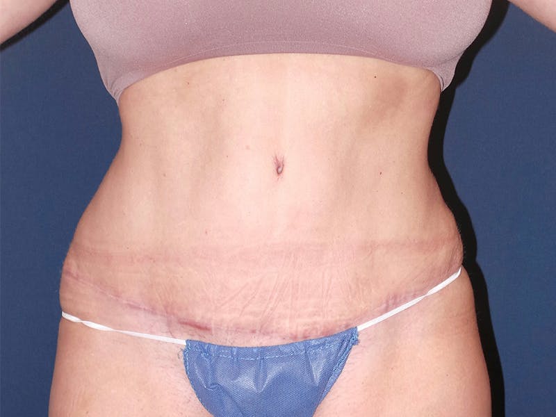 Tummy Tuck by Dr. Booth Before & After Gallery - Patient 90112745 - Image 2