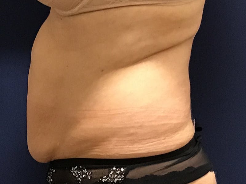 Tummy Tuck by Dr. Booth Before & After Gallery - Patient 90112745 - Image 3