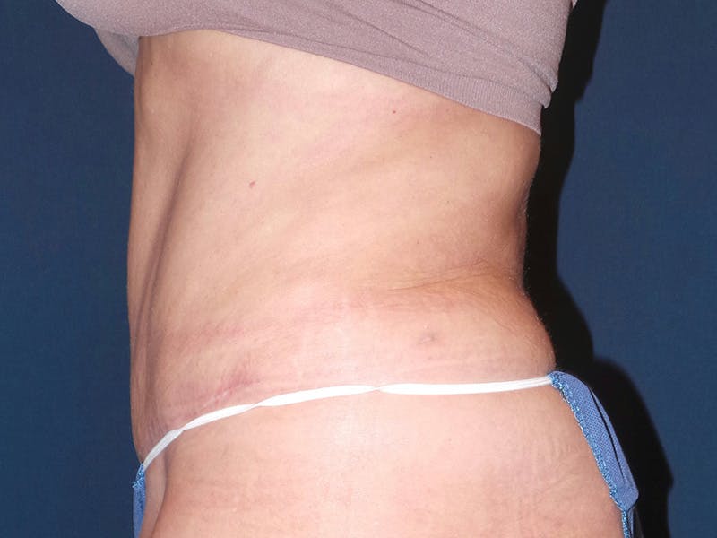Tummy Tuck by Dr. Booth Before & After Gallery - Patient 90112745 - Image 4