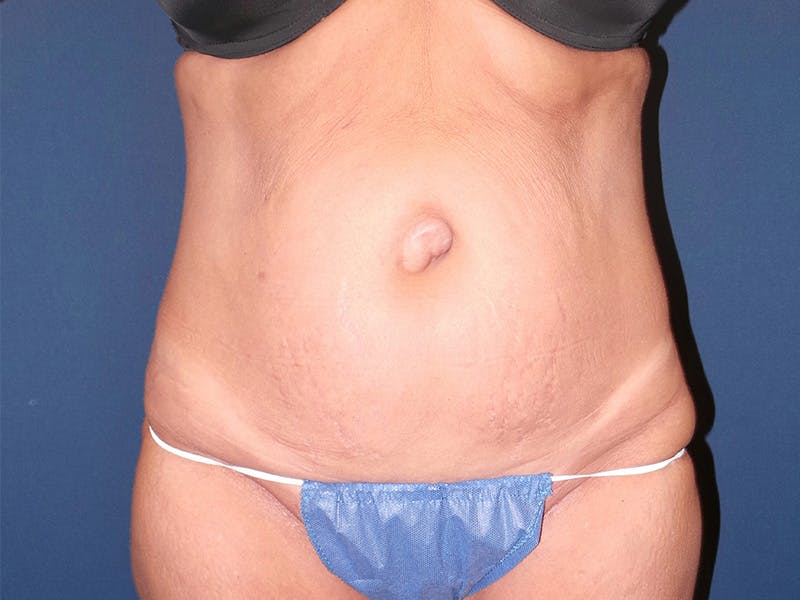 Tummy Tuck by Dr. Booth Before & After Gallery - Patient 90112764 - Image 1