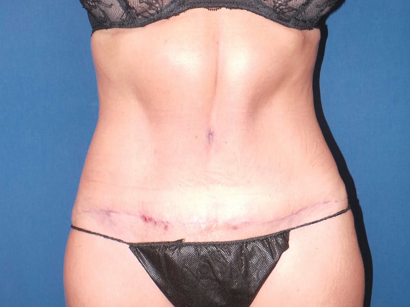 Tummy Tuck by Dr. Booth Before & After Gallery - Patient 90112764 - Image 2