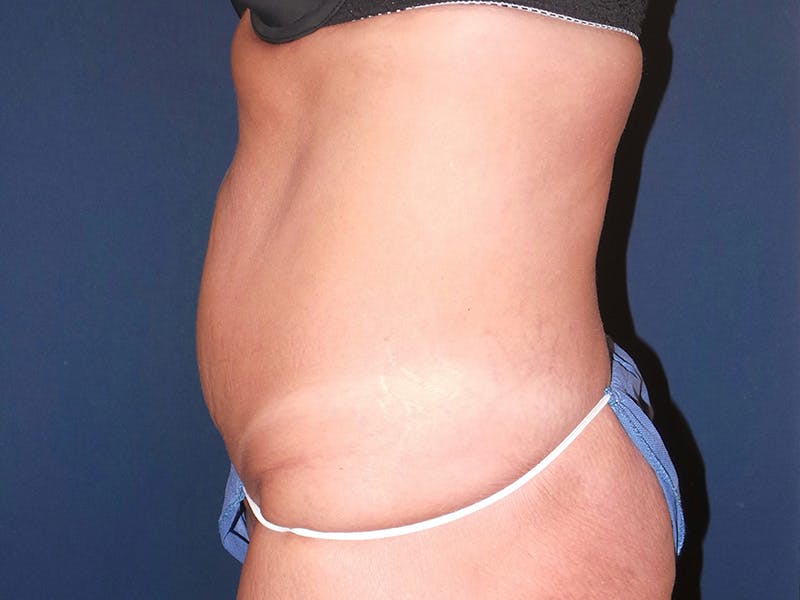 Tummy Tuck by Dr. Booth Before & After Gallery - Patient 90112764 - Image 3