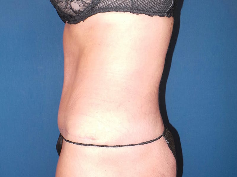 Tummy Tuck by Dr. Booth Before & After Gallery - Patient 90112764 - Image 4