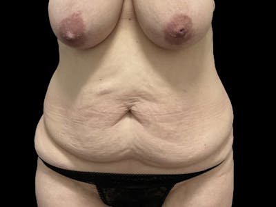 Tummy Tuck by Dr. Booth Before & After Gallery - Patient 410343 - Image 1