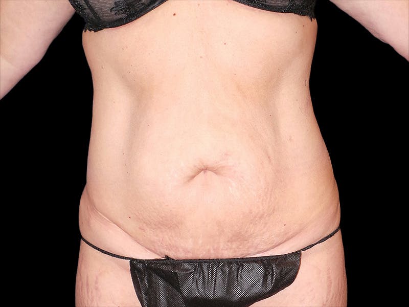 Tummy Tuck by Dr. Booth Before & After Gallery - Patient 416170 - Image 1