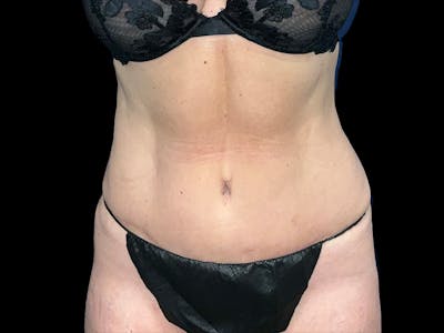 Tummy Tuck by Dr. Booth Before & After Gallery - Patient 416170 - Image 2