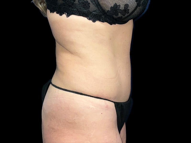 Tummy Tuck by Dr. Booth Before & After Gallery - Patient 416170 - Image 6
