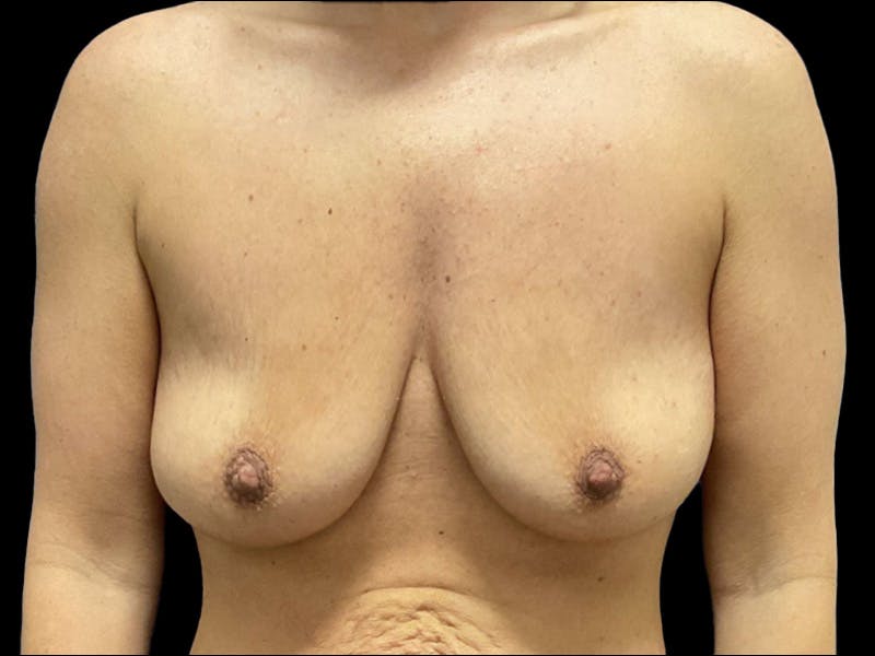 Breast Lift with Augmentation Dr. Booth Before & After Gallery - Patient 237523 - Image 1