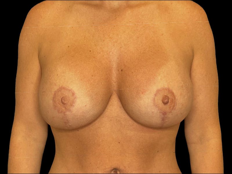  Breast Lift with Augmentation Dr. Booth Before & After Gallery - Patient 237523 - Image 2
