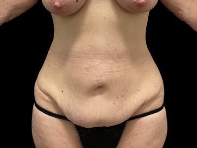 Tummy Tuck by Dr. Booth Before & After Gallery - Patient 401792 - Image 1
