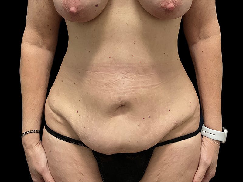 Tummy Tuck by Dr. Booth Before & After Gallery - Patient 401792 - Image 3