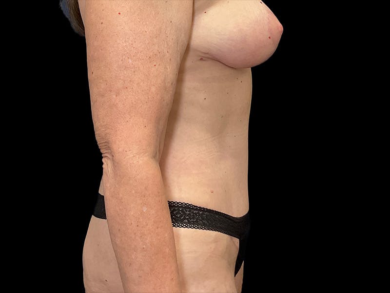 Tummy Tuck by Dr. Booth Before & After Gallery - Patient 401792 - Image 8