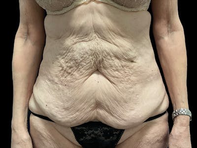 Tummy Tuck by Dr. Booth Before & After Gallery - Patient 323399 - Image 1