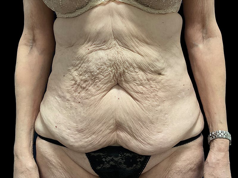 Tummy Tuck by Dr. Booth Before & After Gallery - Patient 323399 - Image 1