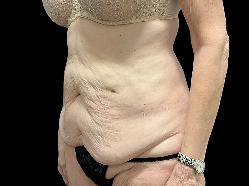 Tummy Tuck by Dr. Booth Before & After Gallery - Patient 323399 - Image 5