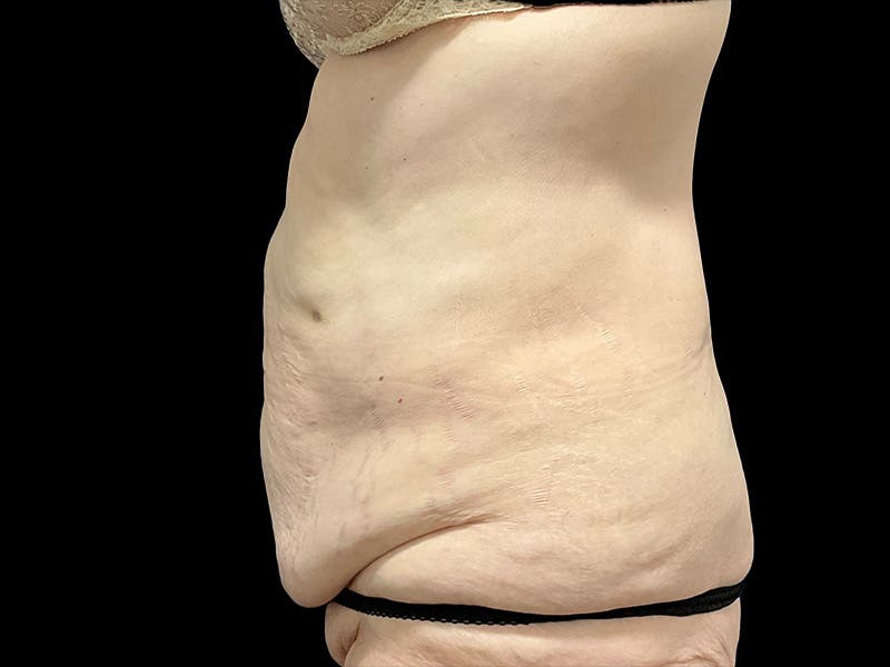 Tummy Tuck by Dr. Booth Before & After Gallery - Patient 323399 - Image 7