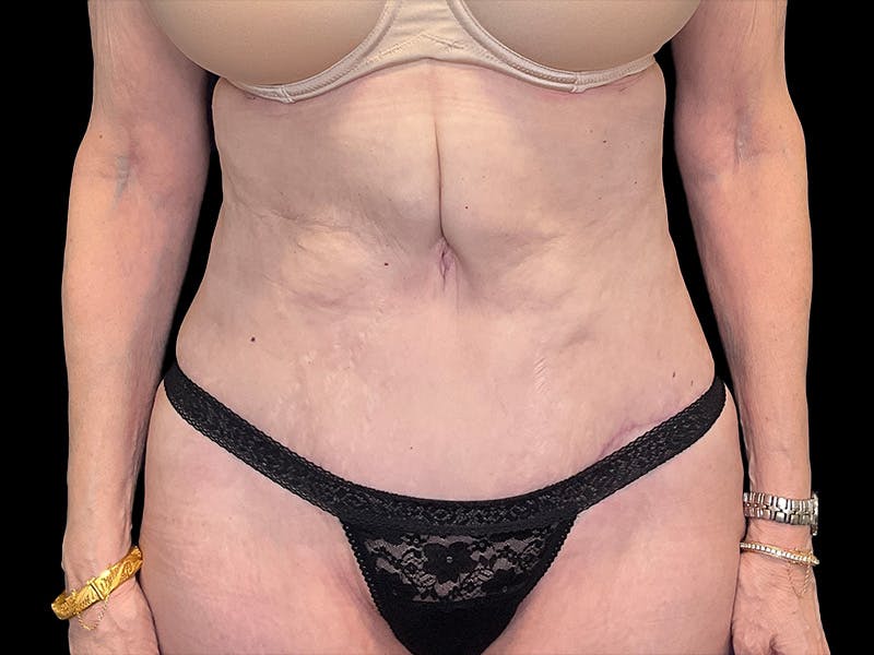 Tummy Tuck by Dr. Booth Before & After Gallery - Patient 323399 - Image 2
