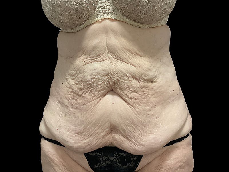 Tummy Tuck by Dr. Booth Before & After Gallery - Patient 323399 - Image 3