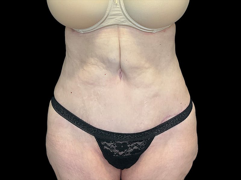 Tummy Tuck by Dr. Booth Before & After Gallery - Patient 323399 - Image 4