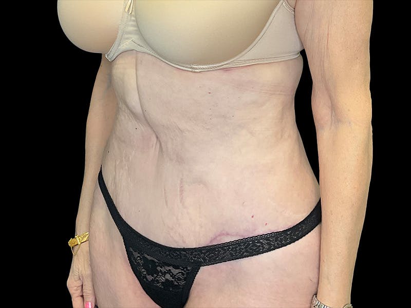 Tummy Tuck by Dr. Booth Before & After Gallery - Patient 323399 - Image 6