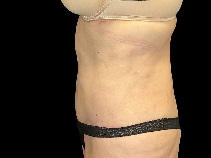 Tummy Tuck by Dr. Booth Before & After Gallery - Patient 323399 - Image 8
