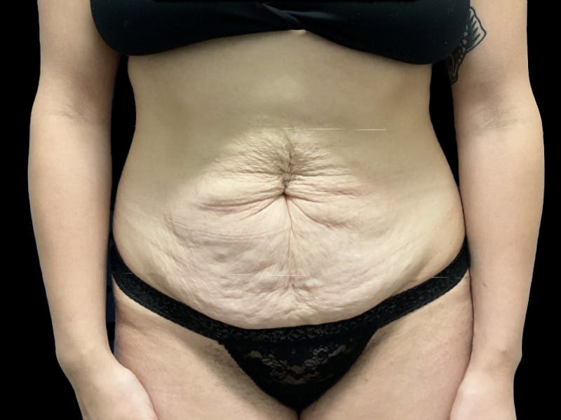 Tummy Tuck by Dr. Booth Before & After Gallery - Patient 282712 - Image 1