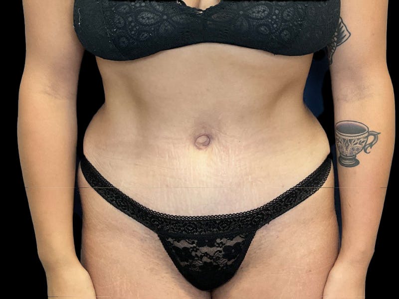 Tummy Tuck by Dr. Booth Before & After Gallery - Patient 282712 - Image 2