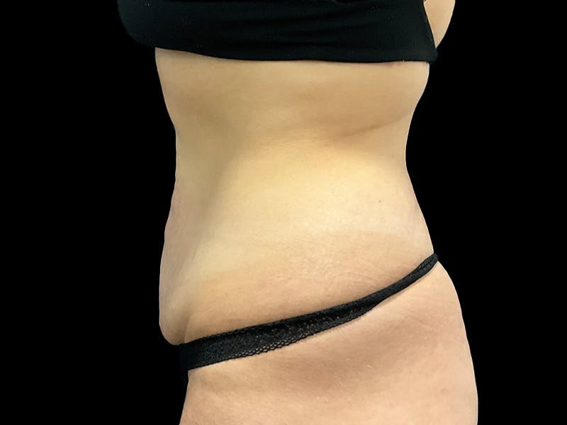 Tummy Tuck by Dr. Booth Before & After Gallery - Patient 282712 - Image 4