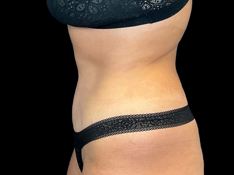 Tummy Tuck by Dr. Booth Before & After Gallery - Patient 282712 - Image 3