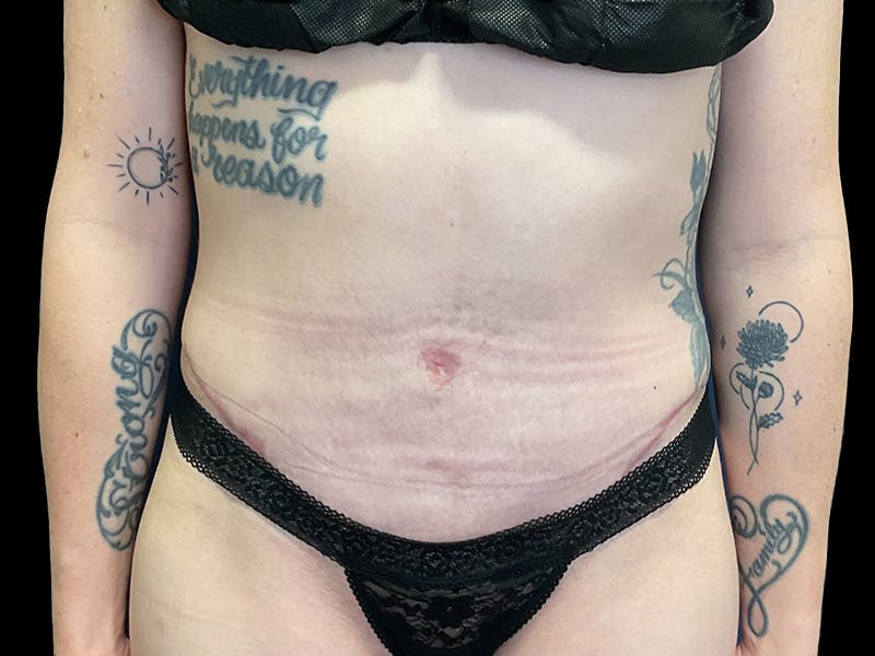 Tummy Tuck by Dr. Booth Before & After Gallery - Patient 107888 - Image 2