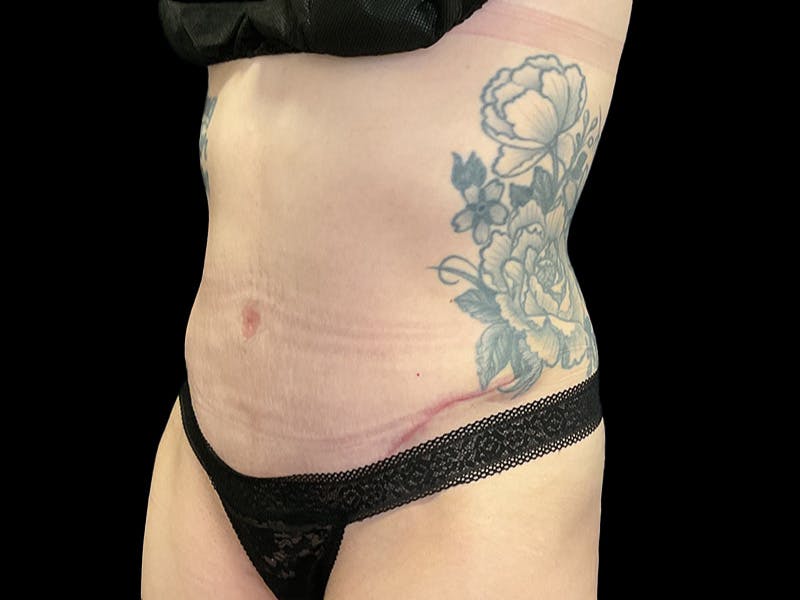 Tummy Tuck by Dr. Booth Before & After Gallery - Patient 107888 - Image 4