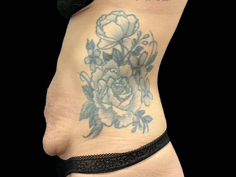 Tummy Tuck by Dr. Booth Before & After Gallery - Patient 107888 - Image 5