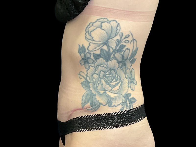 Tummy Tuck by Dr. Booth Before & After Gallery - Patient 107888 - Image 6