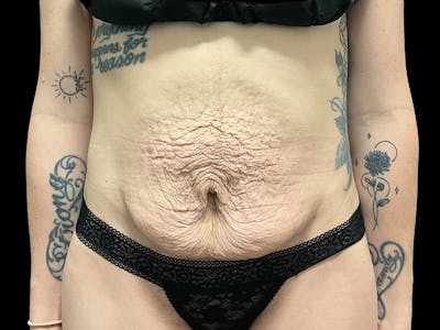 Tummy Tuck by Dr. Booth Before & After Gallery - Patient 107888 - Image 1