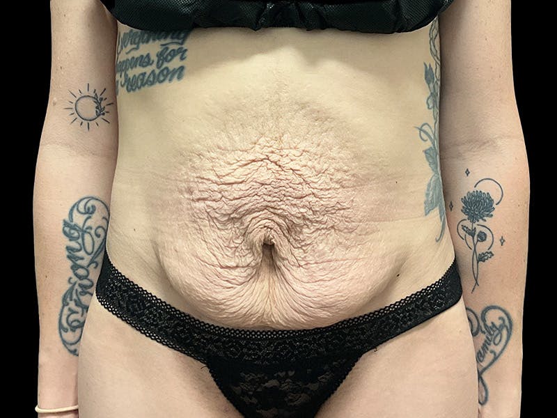 Tummy Tuck by Dr. Booth Before & After Gallery - Patient 107888 - Image 1